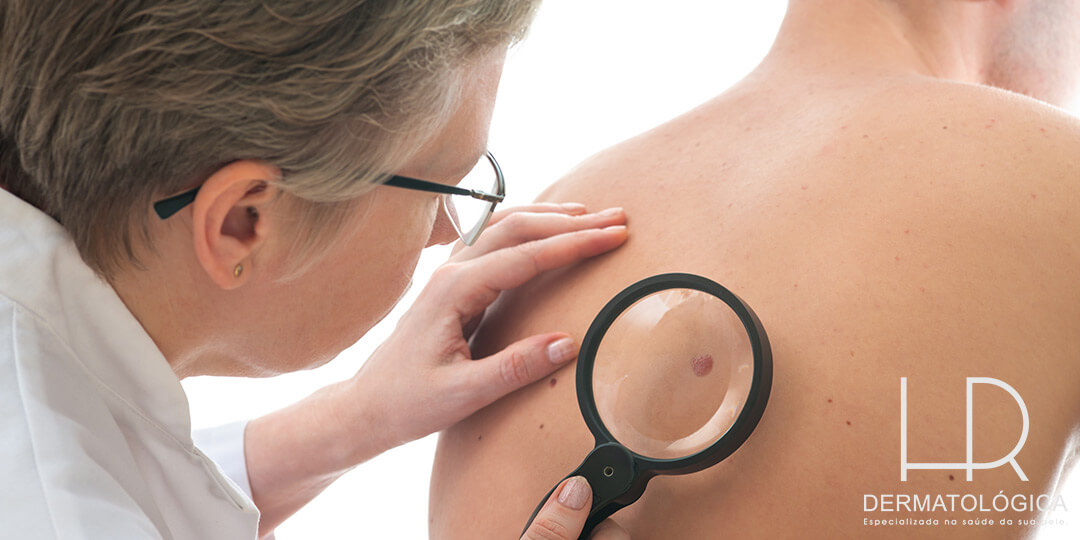Dermatologia Oncológica - câncer de pele